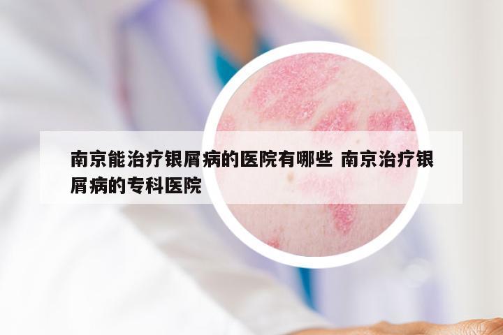 南京能治疗银屑病的医院有哪些 南京治疗银屑病的专科医院
