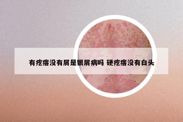 有疙瘩没有屑是银屑病吗 硬疙瘩没有白头