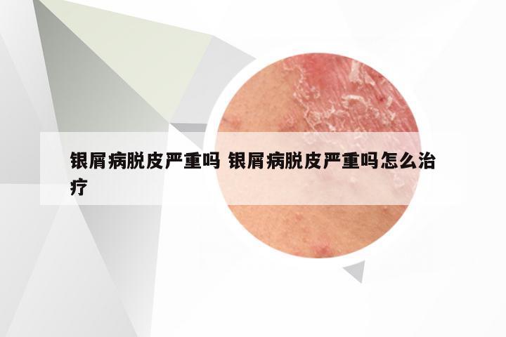 银屑病脱皮严重吗 银屑病脱皮严重吗怎么治疗