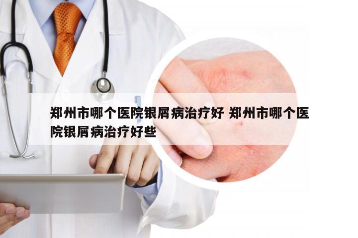 郑州市哪个医院银屑病治疗好 郑州市哪个医院银屑病治疗好些