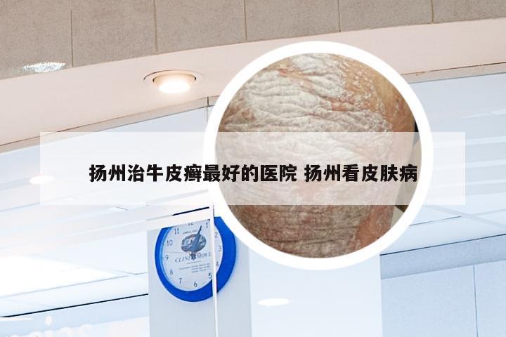扬州治牛皮癣最好的医院 扬州看皮肤病