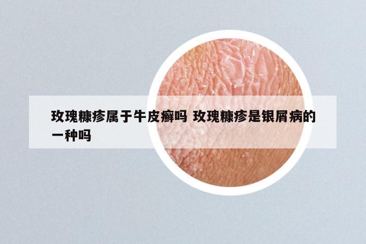 玫瑰糠疹属于牛皮癣吗 玫瑰糠疹是银屑病的一种吗