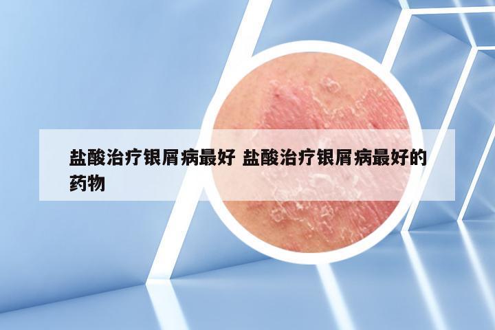 盐酸治疗银屑病最好 盐酸治疗银屑病最好的药物