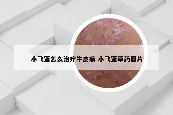 小飞蓬怎么治疗牛皮癣 小飞蓬草药图片