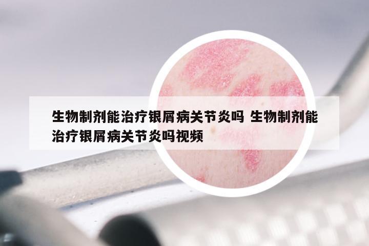 生物制剂能治疗银屑病关节炎吗 生物制剂能治疗银屑病关节炎吗视频