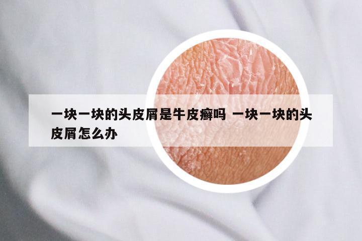一块一块的头皮屑是牛皮癣吗 一块一块的头皮屑怎么办