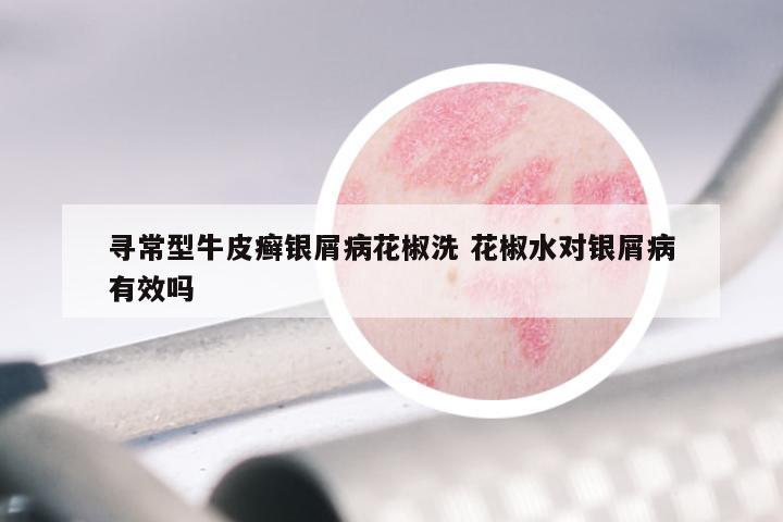 寻常型牛皮癣银屑病花椒洗 花椒水对银屑病有效吗