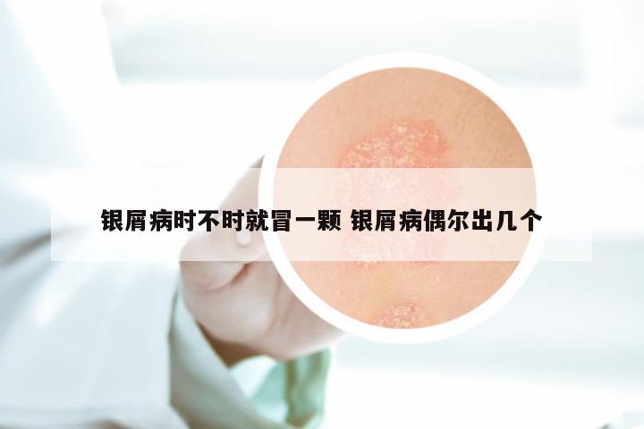 银屑病时不时就冒一颗 银屑病偶尔出几个
