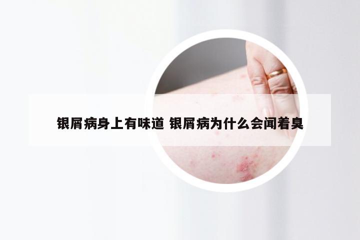 银屑病身上有味道 银屑病为什么会闻着臭