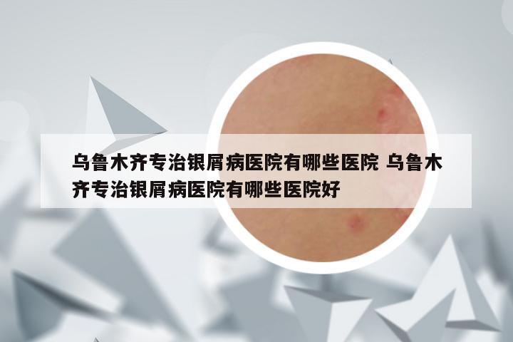 乌鲁木齐专治银屑病医院有哪些医院 乌鲁木齐专治银屑病医院有哪些医院好
