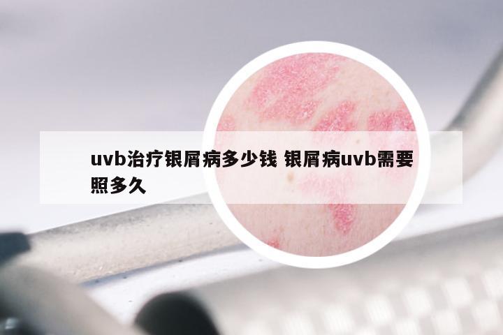 uvb治疗银屑病多少钱 银屑病uvb需要照多久