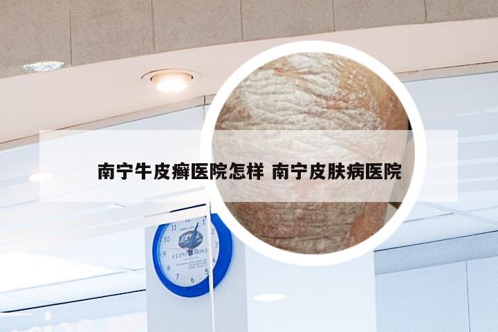 南宁牛皮癣医院怎样 南宁皮肤病医院
