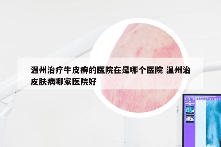 温州治疗牛皮癣的医院在是哪个医院 温州治皮肤病哪家医院好