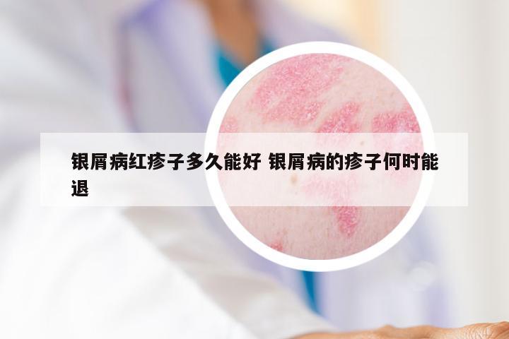 银屑病红疹子多久能好 银屑病的疹子何时能退