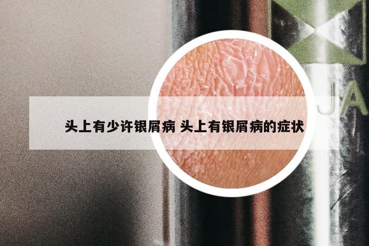 头上有少许银屑病 头上有银屑病的症状