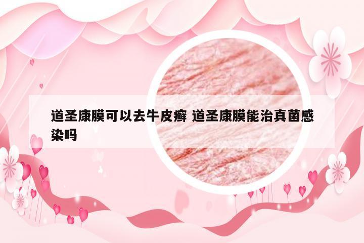 道圣康膜可以去牛皮癣 道圣康膜能治真菌感染吗