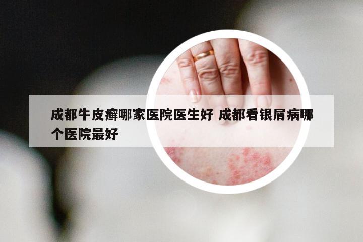 成都牛皮癣哪家医院医生好 成都看银屑病哪个医院最好