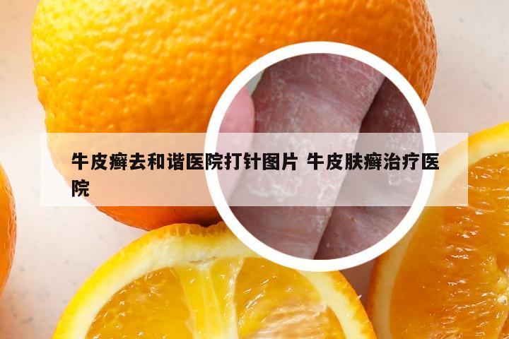 牛皮癣去和谐医院打针图片 牛皮肤癣治疗医院