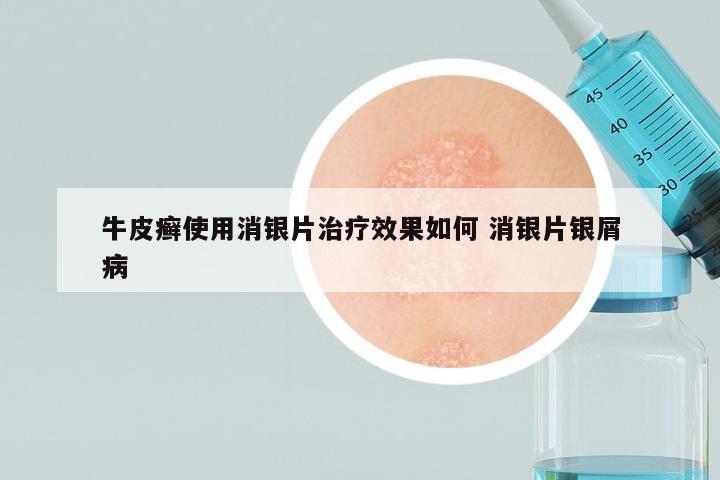 牛皮癣使用消银片治疗效果如何 消银片银屑病