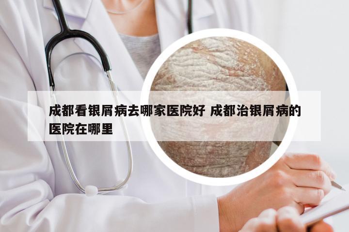 成都看银屑病去哪家医院好 成都治银屑病的医院在哪里
