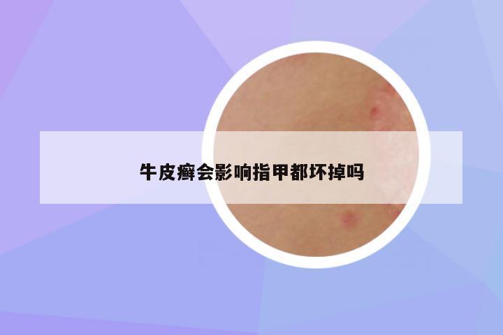 牛皮癣会影响指甲都坏掉吗