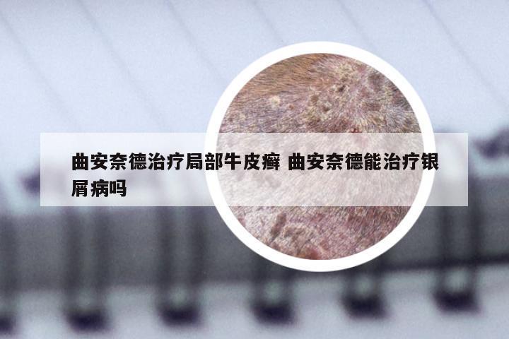 曲安奈德治疗局部牛皮癣 曲安奈德能治疗银屑病吗
