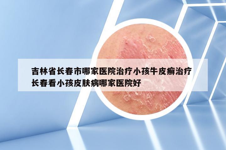 吉林省长春市哪家医院治疗小孩牛皮癣治疗 长春看小孩皮肤病哪家医院好