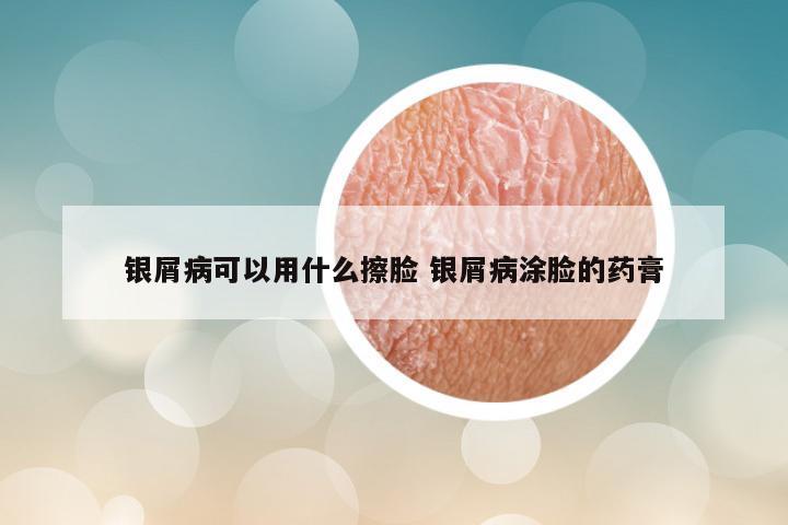 银屑病可以用什么擦脸 银屑病涂脸的药膏