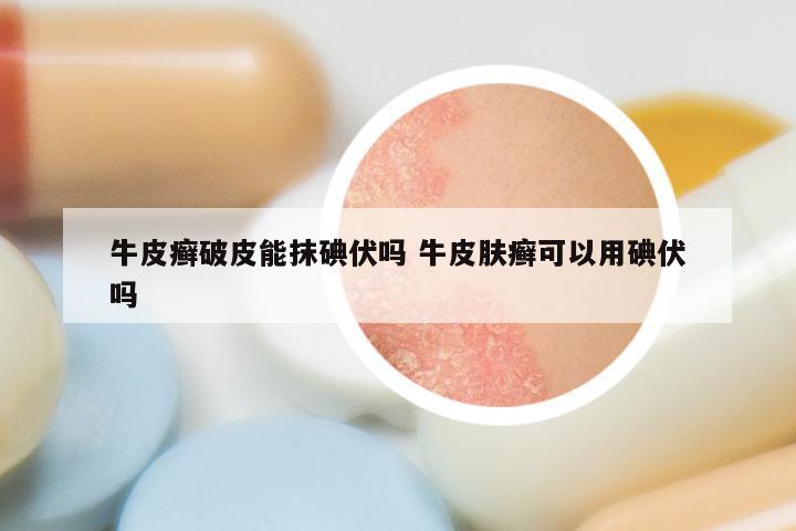 牛皮癣破皮能抹碘伏吗 牛皮肤癣可以用碘伏吗