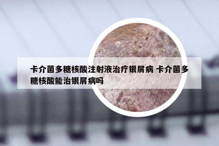 卡介菌多糖核酸注射液治疗银屑病 卡介菌多糖核酸能治银屑病吗