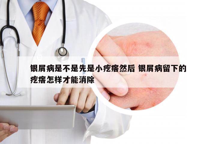 银屑病是不是先是小疙瘩然后 银屑病留下的疙瘩怎样才能消除