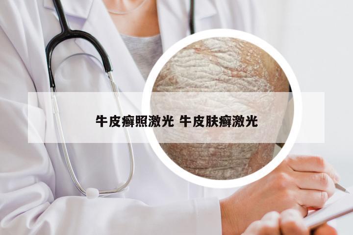 牛皮癣照激光 牛皮肤癣激光