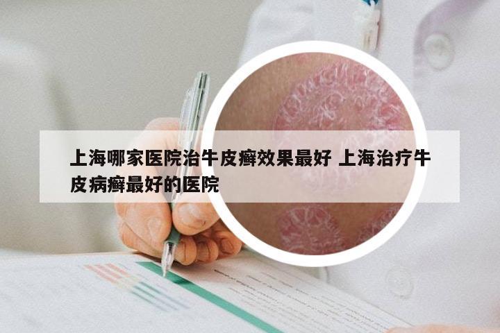 上海哪家医院治牛皮癣效果最好 上海治疗牛皮病癣最好的医院