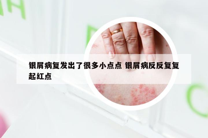 银屑病复发出了很多小点点 银屑病反反复复起红点