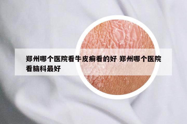 郑州哪个医院看牛皮癣看的好 郑州哪个医院看脑科最好