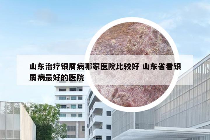山东治疗银屑病哪家医院比较好 山东省看银屑病最好的医院