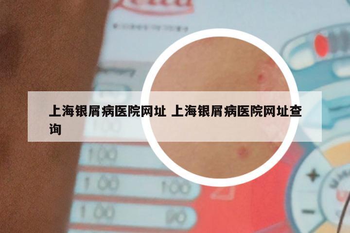上海银屑病医院网址 上海银屑病医院网址查询