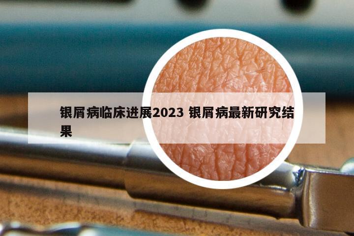 银屑病临床进展2023 银屑病最新研究结果