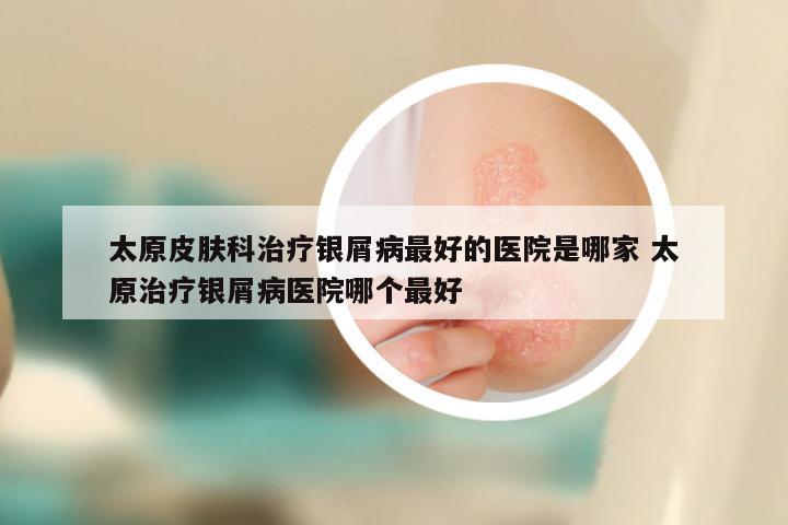 太原皮肤科治疗银屑病最好的医院是哪家 太原治疗银屑病医院哪个最好