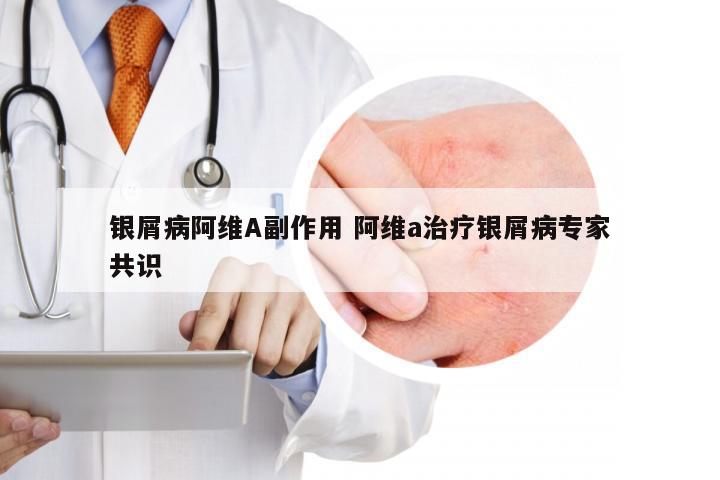 银屑病阿维A副作用 阿维a治疗银屑病专家共识