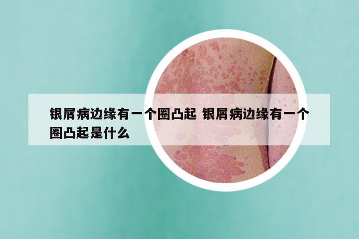 银屑病边缘有一个圈凸起 银屑病边缘有一个圈凸起是什么