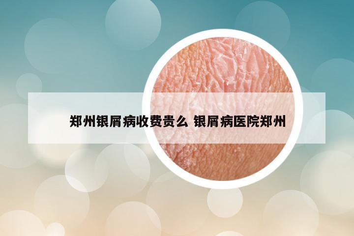 郑州银屑病收费贵么 银屑病医院郑州