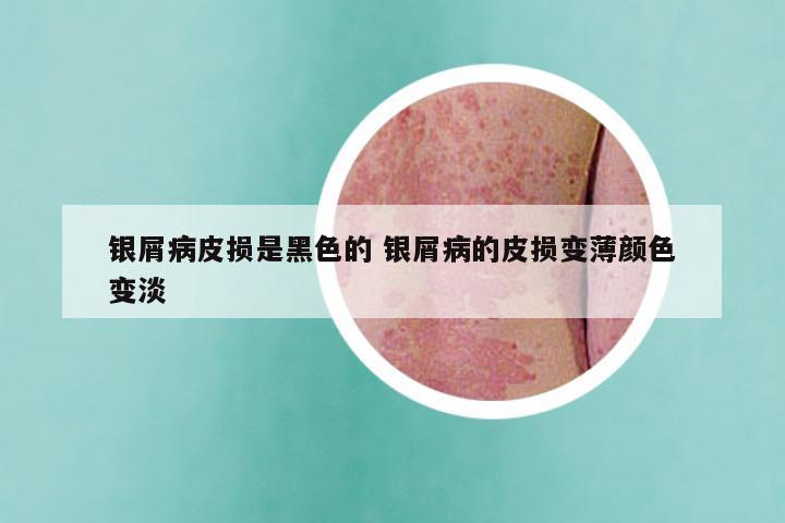 银屑病皮损是黑色的 银屑病的皮损变薄颜色变淡
