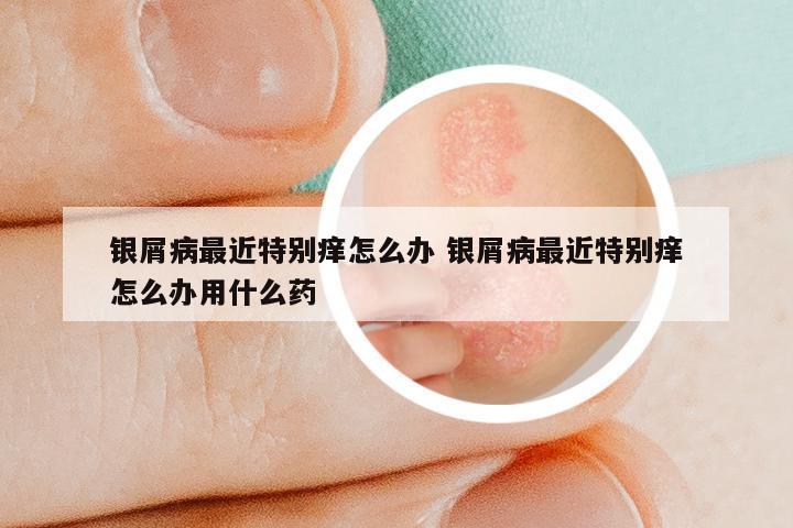 银屑病最近特别痒怎么办 银屑病最近特别痒怎么办用什么药