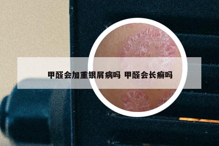 甲醛会加重银屑病吗 甲醛会长癣吗