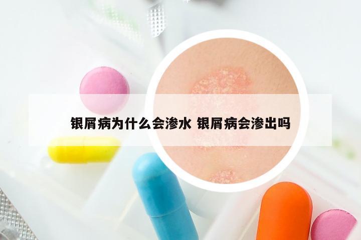银屑病为什么会渗水 银屑病会渗出吗