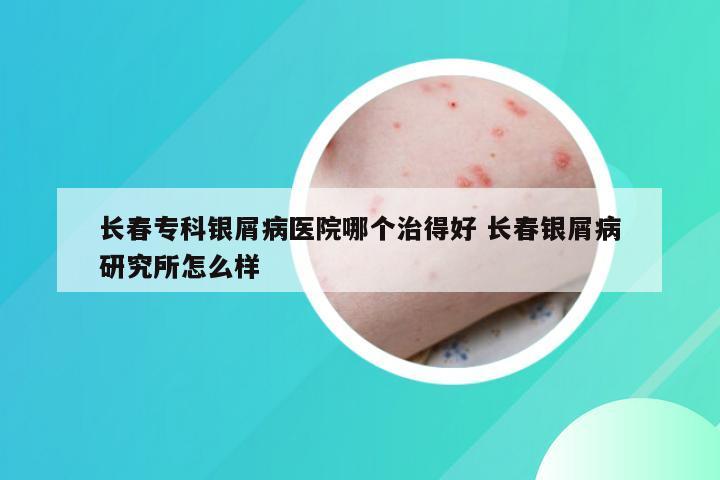 长春专科银屑病医院哪个治得好 长春银屑病研究所怎么样
