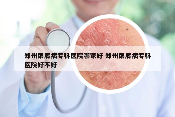 郑州银屑病专科医院哪家好 郑州银屑病专科医院好不好