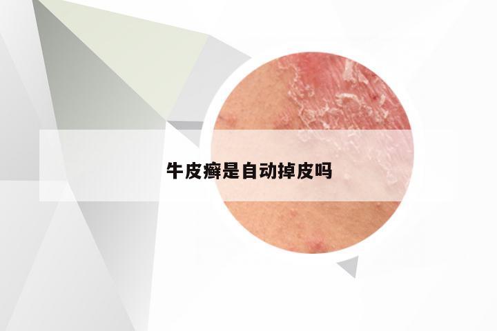牛皮癣是自动掉皮吗