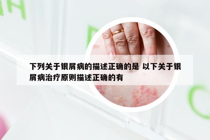 下列关于银屑病的描述正确的是 以下关于银屑病治疗原则描述正确的有